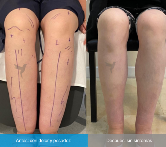 El lipedema, la enfermedad más desconocida por los médicos: 20 años para recibir un diagnóstico