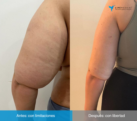 El lipedema, la enfermedad más desconocida por los médicos: 20 años para recibir un diagnóstico